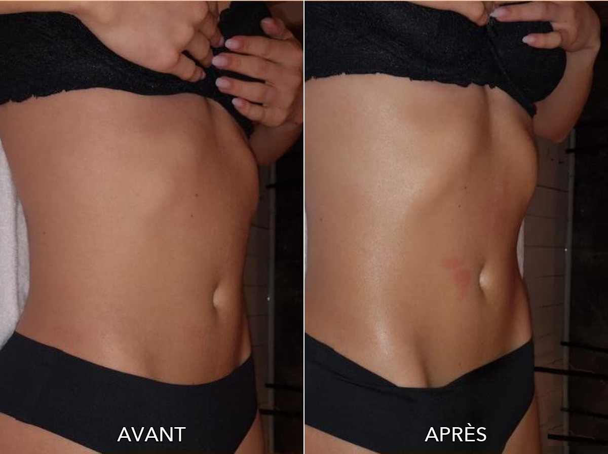 Résultats Avant / Après Cure Minceur Ventre et Taille Maison JOA